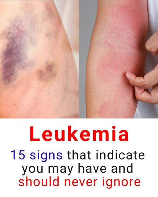 15 Warning Signs of Leukemia You Should Never Ignore