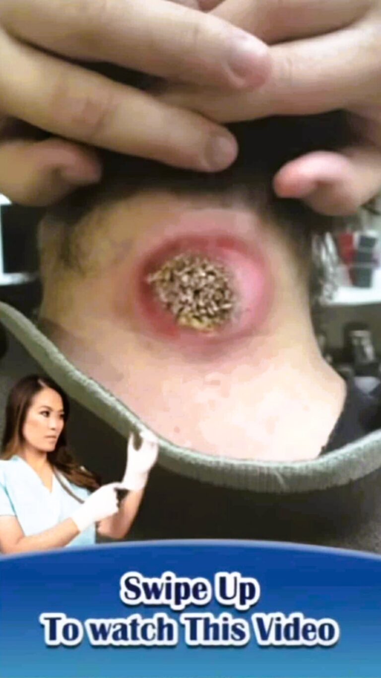 Their acne is severe