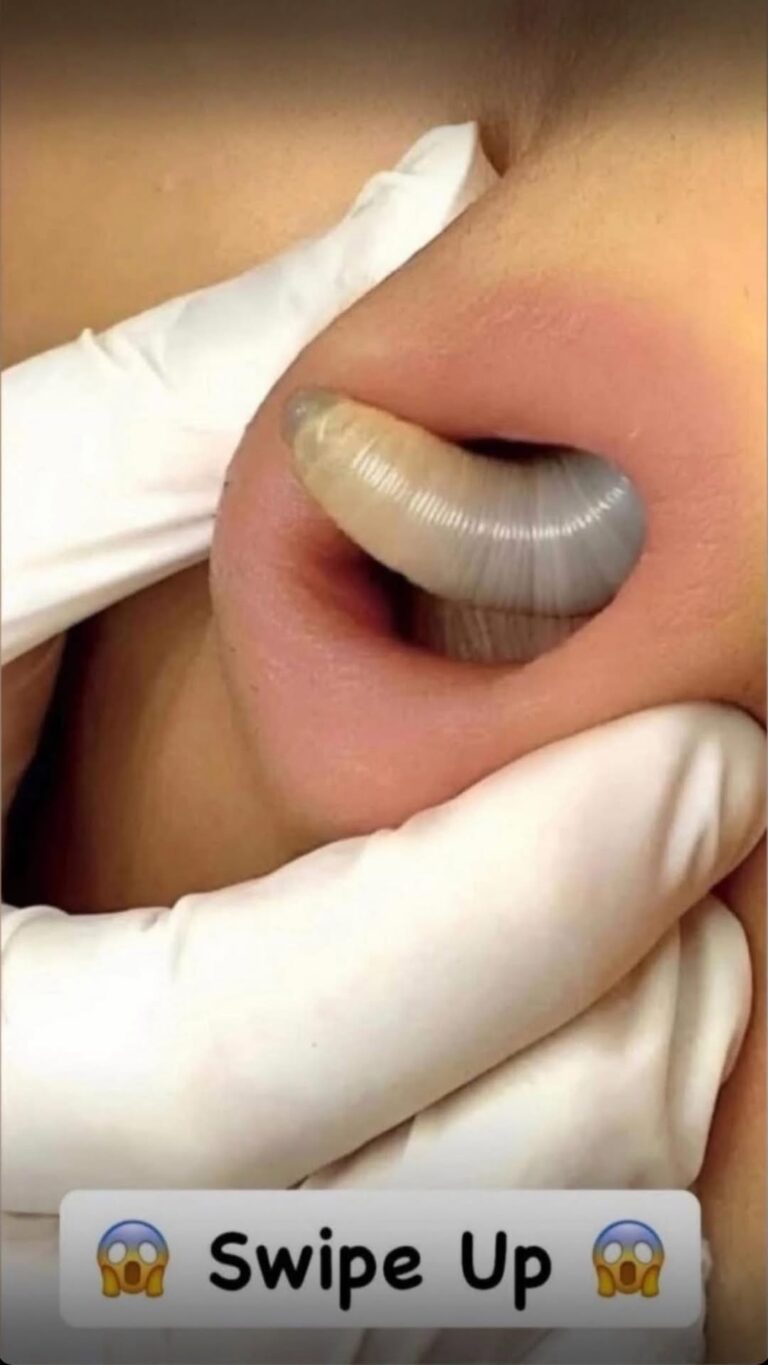 Their acne is severe