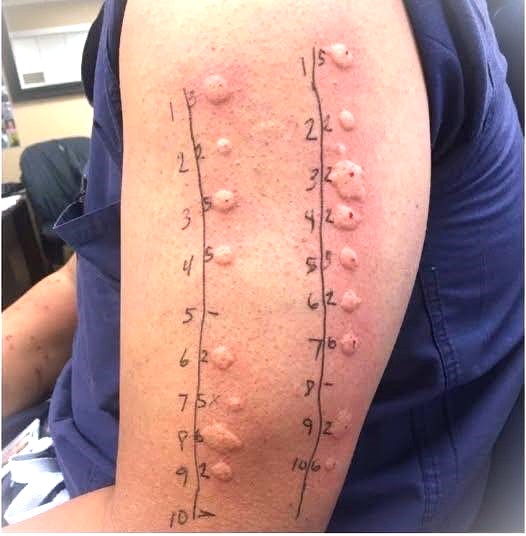 How Allergy Testing Works and Why It’s Essential for Long-Term Relief