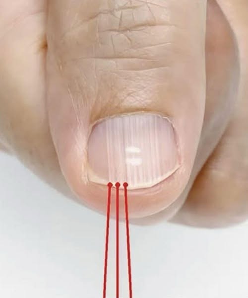 If you have these lines on your nails..
