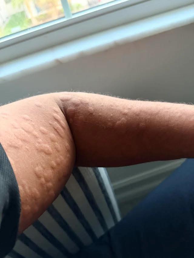 I started babysitting my neighbors son about 2 days ago and he started having these spots appear on him a few hours after he came from his friend house and since I was around him and putting him to sleep when I woke up this morning I had these inflamed itchy spots all over my upper body… what is this