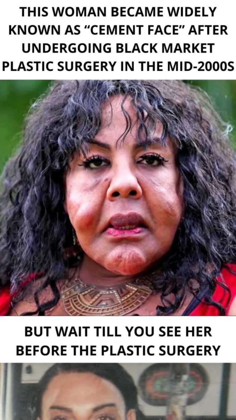 Injected with Cement! Her Unbelievable Transformation 14 Years Later!