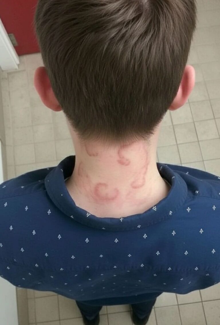 When “Just Hives” Turn Dangerous: A Frightening Lesson in Severe Urticaria and Angio-Oedema