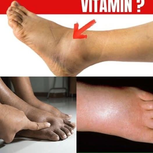 The No.1 Vitamin for Removing Leg and Foot Swelling!