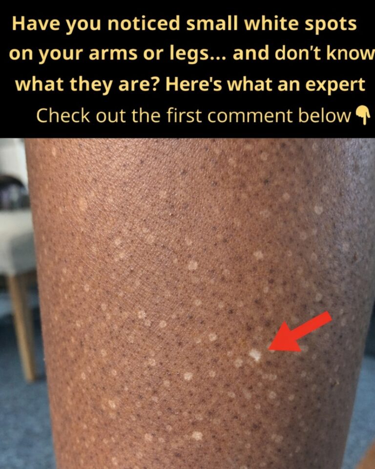 Why Do White Spots Appear on Your Skin? Common Causes Explained