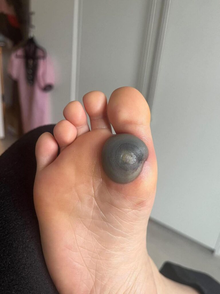 My daughter woke up with this huge spot on her foot I don’t know what it could be. She’s been in pain and can’t move her foot what is this.. Explain this