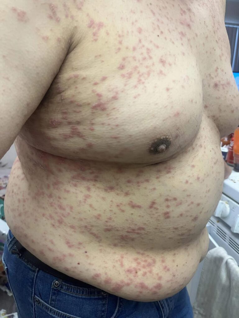 This is on my dad he’s 63, it’s very itchy to him on his whole body, scalp is itchy and face was swollen , face isn’t swollen as bad as it was but the dots are all over…