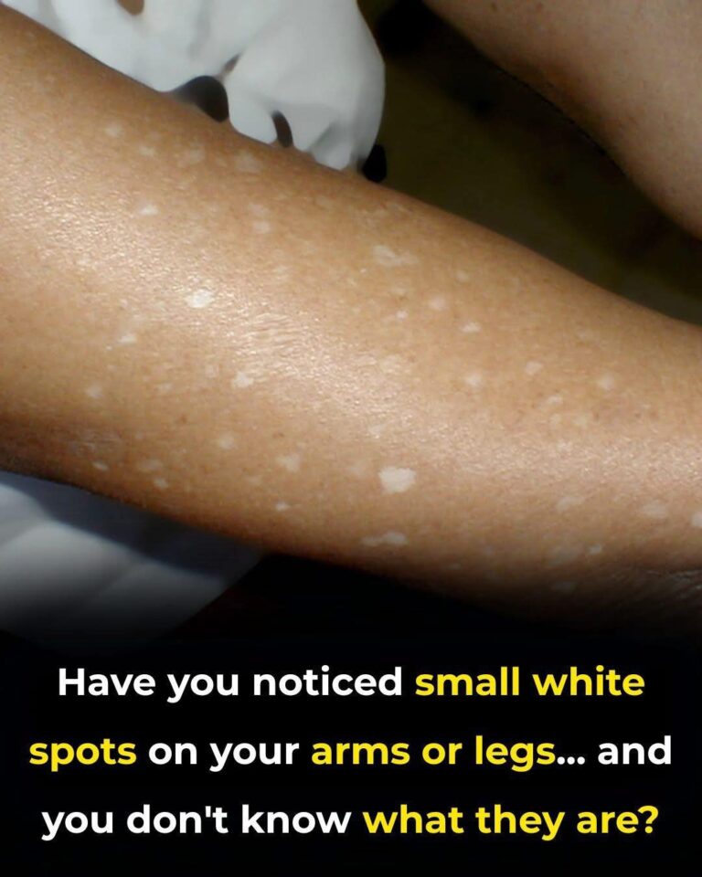 Have you noticed small white spots on your arms or legs… and you don’t know what they are?