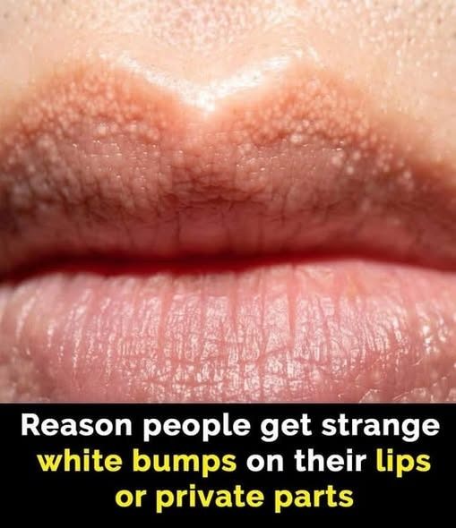 What Are Those White Bumps That Can Appear on Your Private Parts—and What Causes Them?