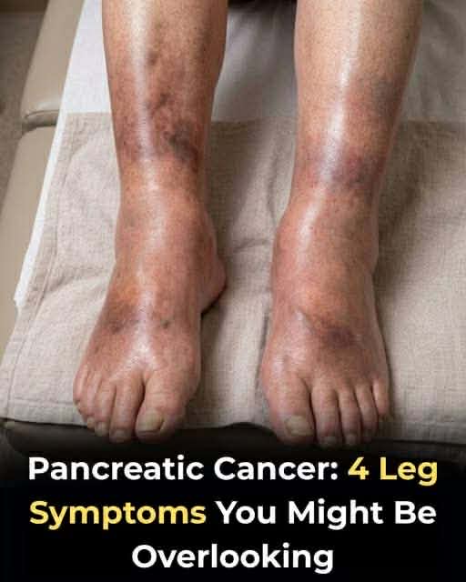 The silent signal: What your swollen legs may reveal about pancreatic cancer