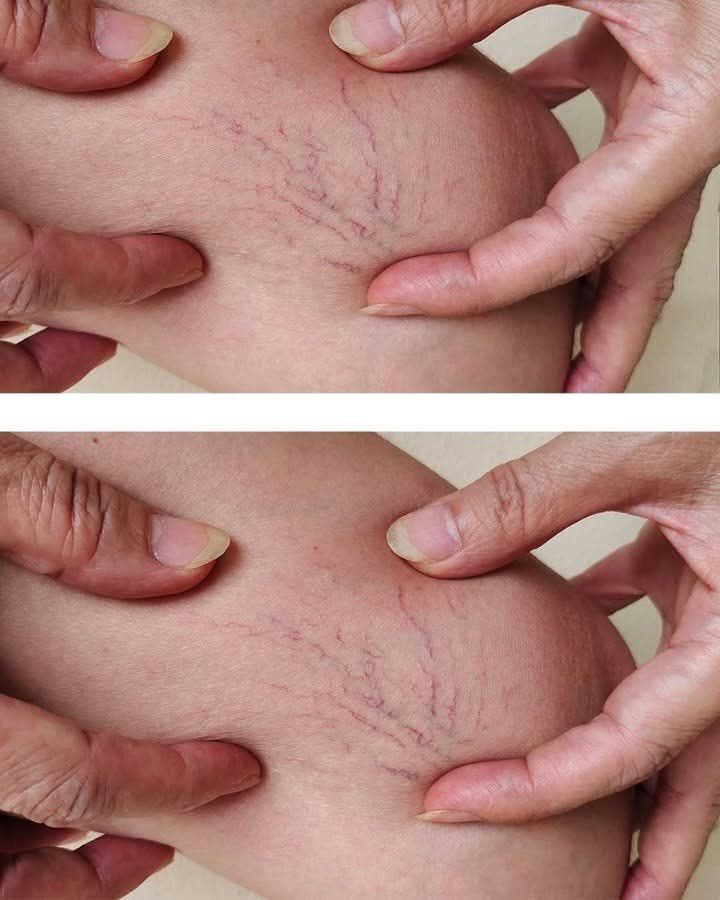 Noticing Red Veins on Your Thighs