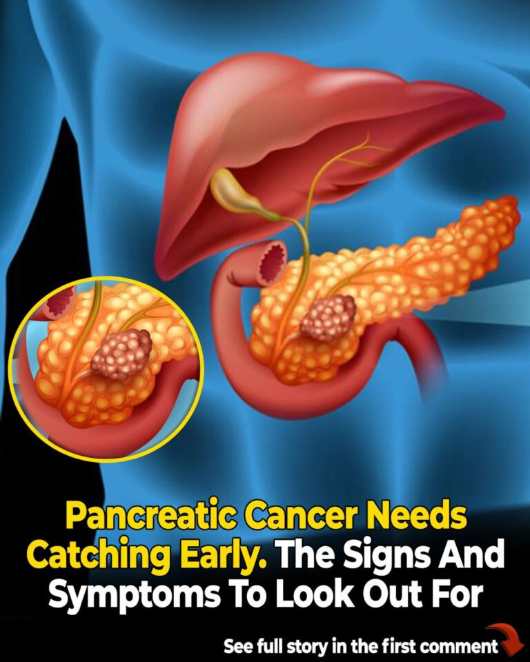 10 Signs of Pancreatic Cancer You Should Never Ignore
