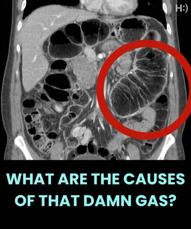Frequent Intestinal Gas Explained, Revealing Hidden Causes Like Poor Digestion, Food Intolerances, SIBO, And Gut Imbalances, While Highlighting How Eating Habits, Fermentable Foods, And Swallowed Air Contribute To Bloating..