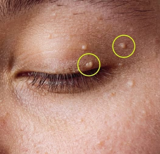 How to Get Rid of Milia: Simple Home Remedies Like Steam, Honey, Lemon, Sugar, and Pomegranate Peel That May Help Reduce Those Small White Keratin Cysts on the Face While Experts Warn Against Squeezing Them to Prevent Skin Damage and Possible Infection