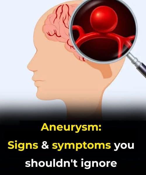12 signs that may signal a brain aneurysm — Don’t ignore them