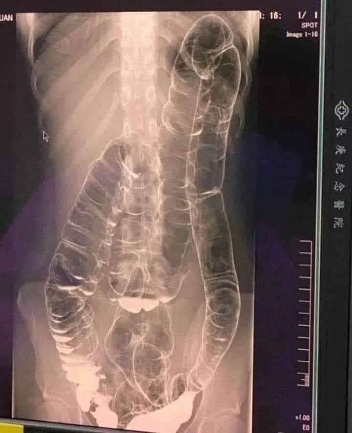 Severe Constipation and Toxic Megacolon: Causes and Solutions