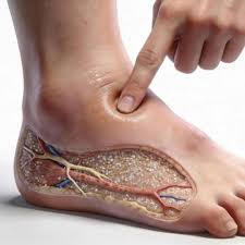 Doctors Hate This Simple Secret to Erase Swollen Feet Forever
