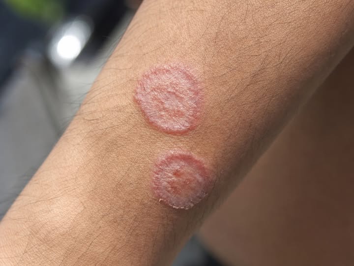 HIDDEN DANGERS LURKING ON YOUR SKIN THAT COULD KILL YOU IN MINUTES