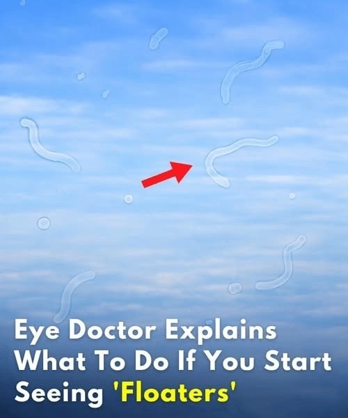 What to Do If You Start Seeing Eye Floaters