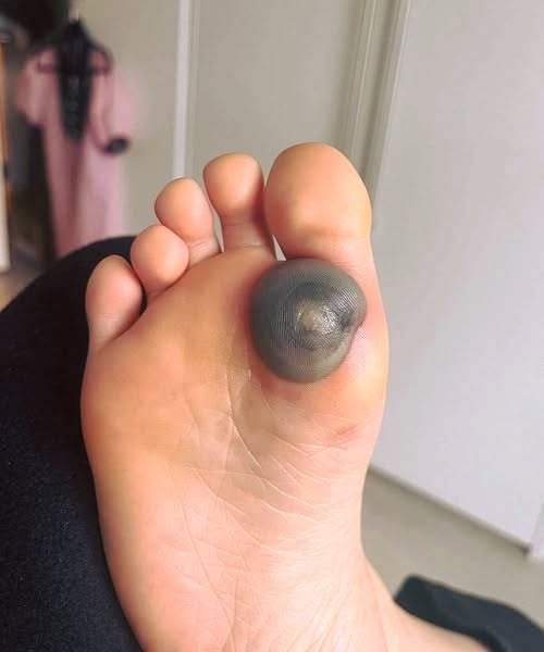 My Daughter Woke Up With a Large Spot on Her Foot and Is in Pain — I’m Not Sure What It Could Be