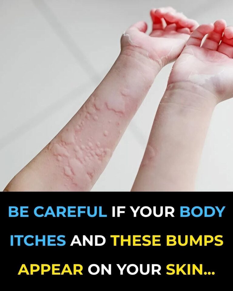 The Hidden Terror on Your Skin: Why Those Mysterious Red Welts Are a Warning You Can’t Afford to Ignore