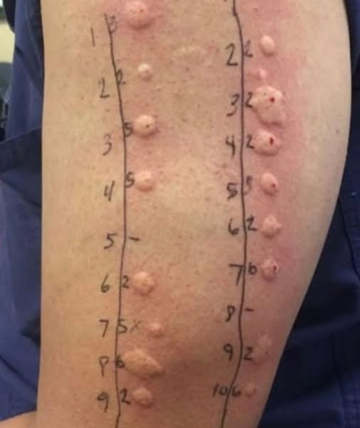 The Silent Virus Within: Understanding Shingles and How to Take Control of Your Health