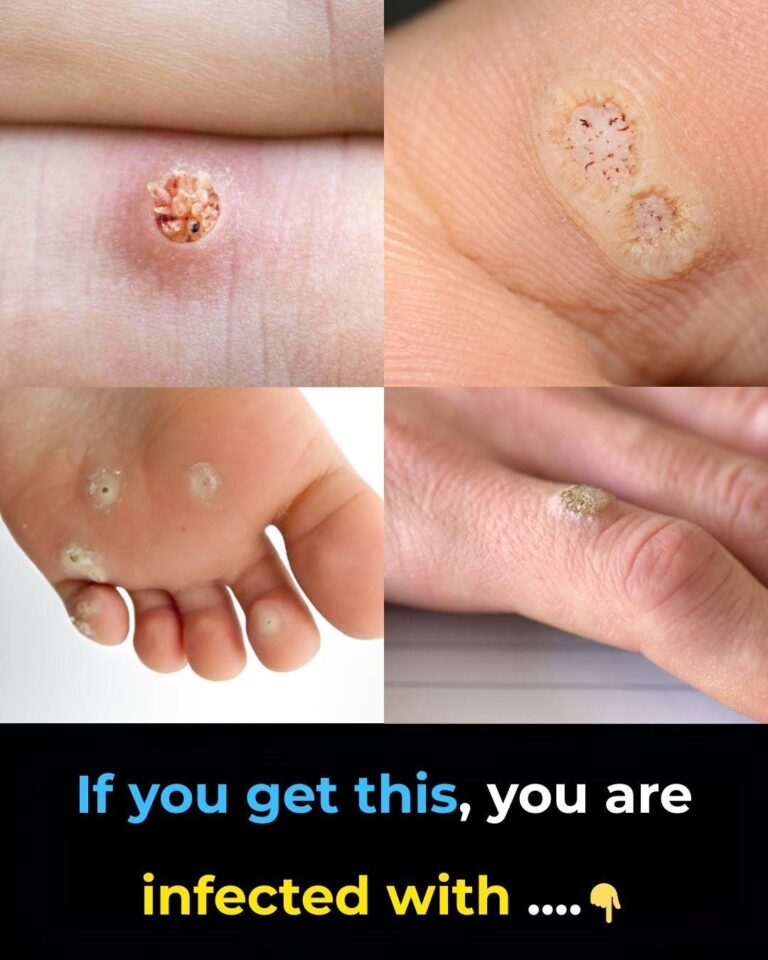 Doctors Warn Millions Ignore These Tiny Skin Growths—Knowing the Different Types of Warts Could Save You From Bigger Problems Later