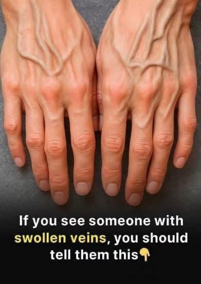 What Do Visible Veins Really Mean? Understanding the Causes and When to Pay Attention
