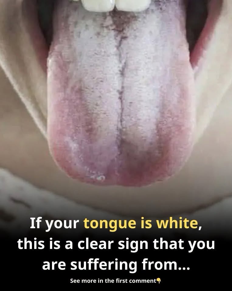 A White Coating on Your Tongue