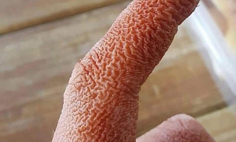 The Mysterious Rash That Nearly Destroyed My Health: The Terrifying Truth About Sweet Syndrome