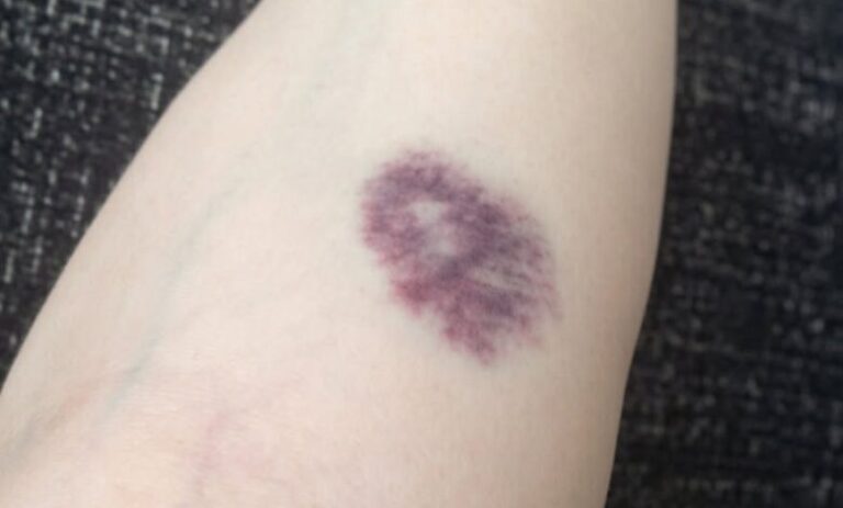 THE SILENT KILLER ON YOUR SKIN: Why Those Mysterious Bruises Are Screaming for Your Attention