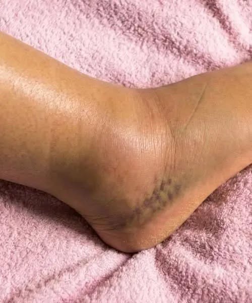 Swollen Legs: Understanding the Symptoms, Causes