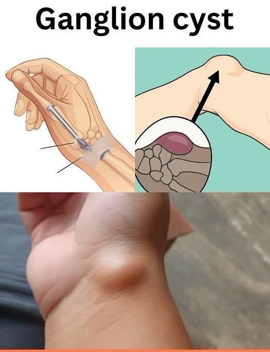 This Small Lump on the Wrist May Be Caused by a Habit You Do Every Day