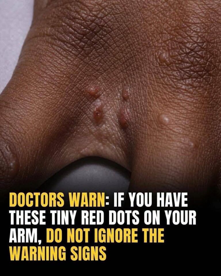 Is That Itchy Rash on Your Hands Actually a Hidden Danger? The Secret Signs of Dyshidrotic Eczema You Can’t Afford to Ignore