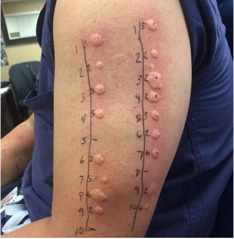 The Shocking Marks on His Arm Revealed What He Had Been Sleeping With for Months