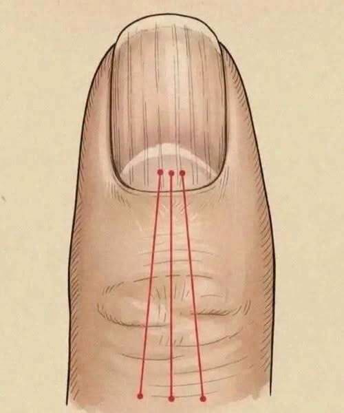 If You Have These Lines on Your Nails, You Should Pay Attention: Experts Explain That Changes in Nail Texture, Such as Ridges or Lines, Can Sometimes Reflect Normal Aging, Minor Injury, or Nutritional Factors, but Persistent or Sudden Changes May Also Signal Underlying Health Conditions—Highlighting the Importance of Monitoring Nail Health and Seeking Medical Advice if Unusual Signs Persist