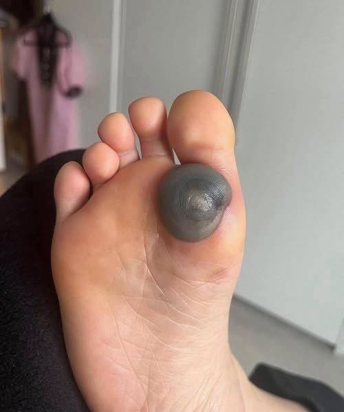 Terrifying Dark Spot On Your Child Foot Might Be A Medical Nightmare You Are Ignoring
