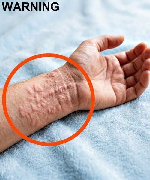 These Are the Consequences of Sleeping With a Bed Bug Infestation